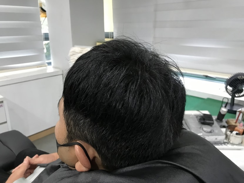 1차 시술 직후 사진
