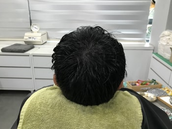 1차 시술 직후 사진
