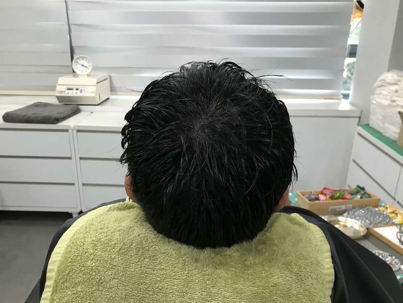 1차 시술 직후 사진