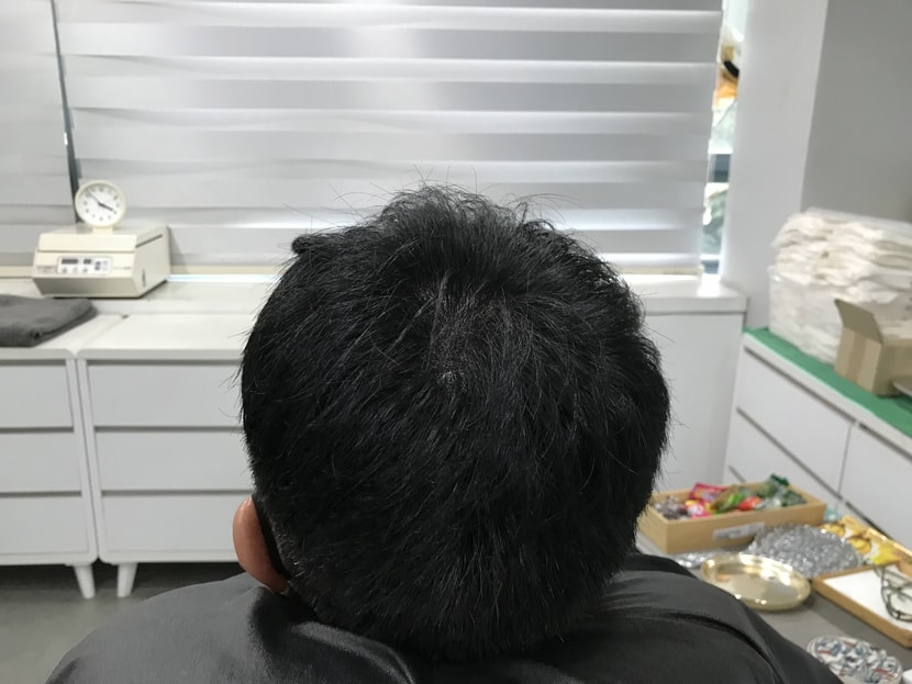 1차 시술 직후 사진