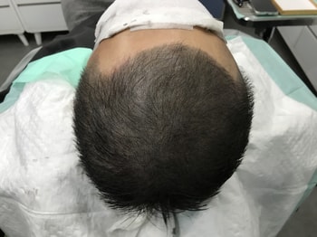 리터치 후 