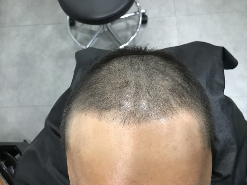 연세미다인 2차 리터치 후