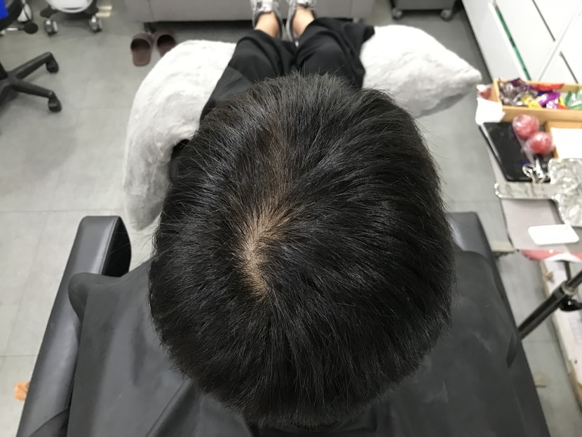 &lt;시술 전 머리 1&gt;