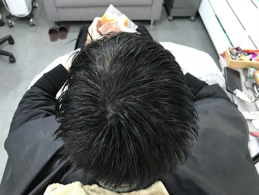 &lt;시술 후 머리 1&gt;