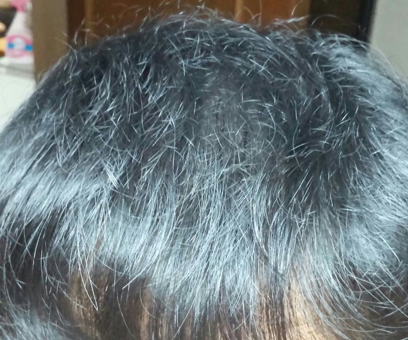 这是头皮纹身第一次修复后记