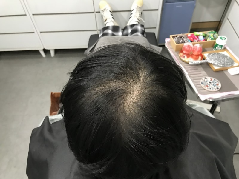 スジチム微細ドットの1次体験談です