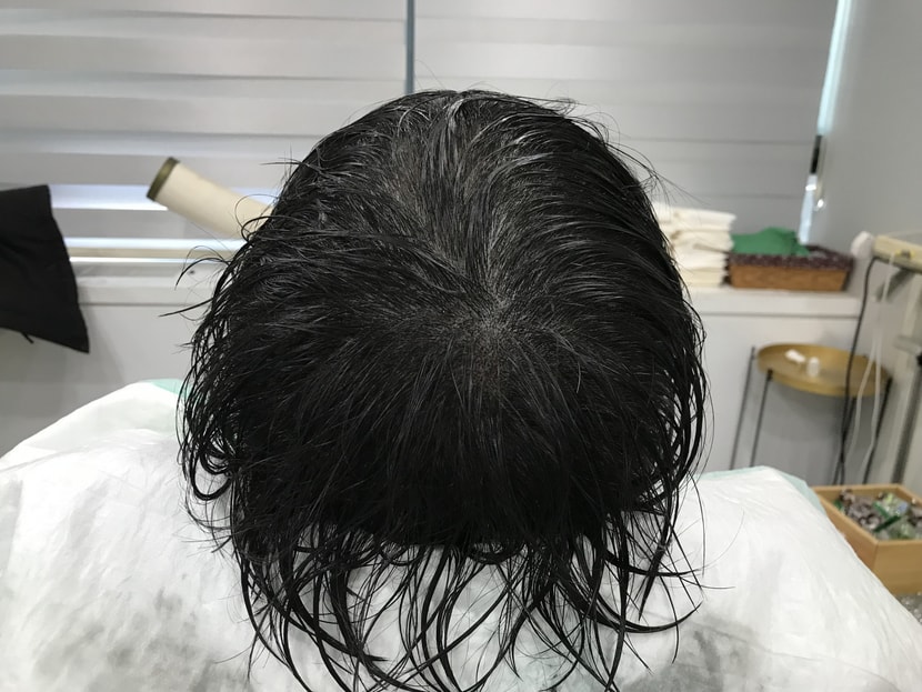 &lt;2차 리터치 시술 후&gt;