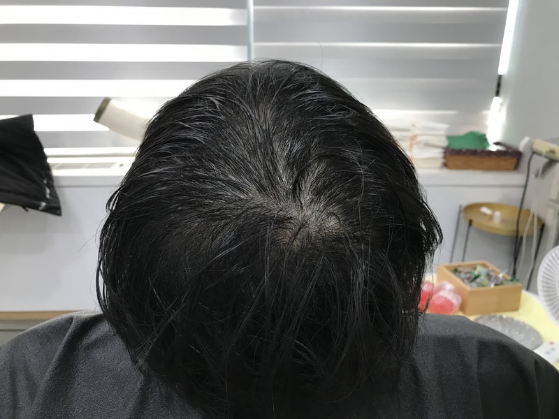 スジチム微細ドットの2次体験談です