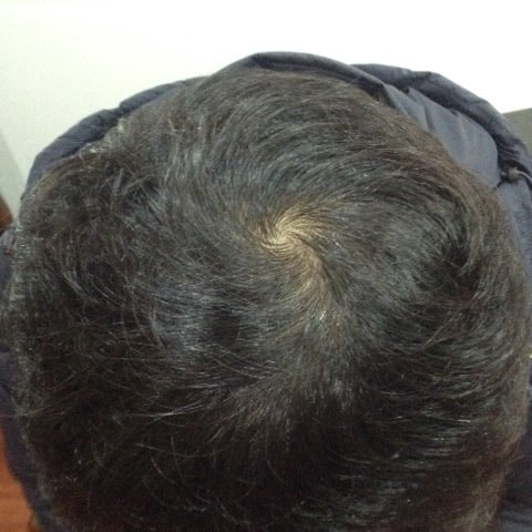 두피문신 해볼만한듯 (사진포함)