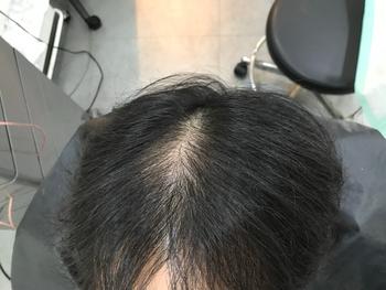 시술전