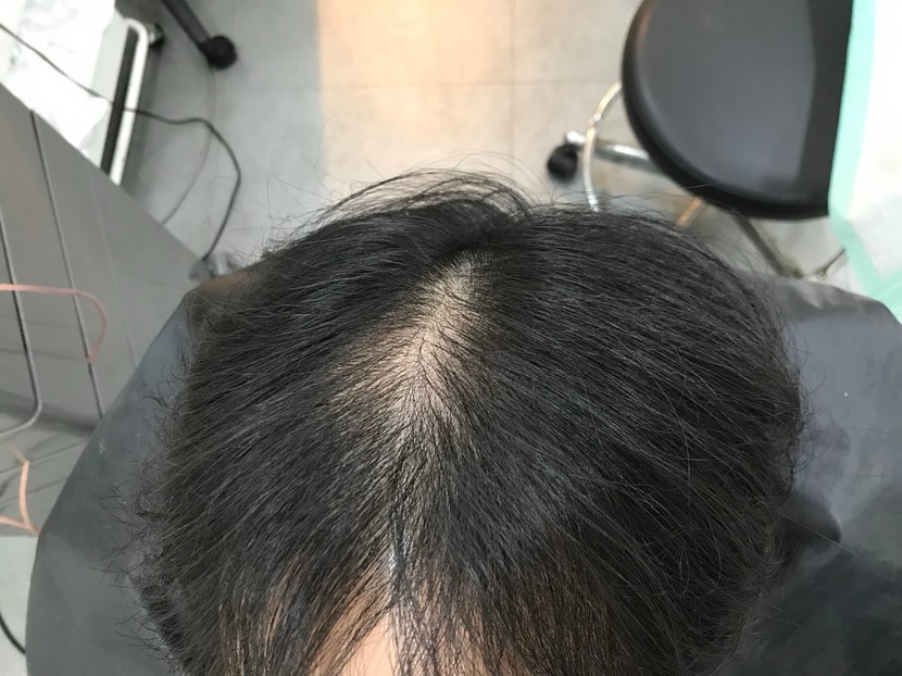 시술전