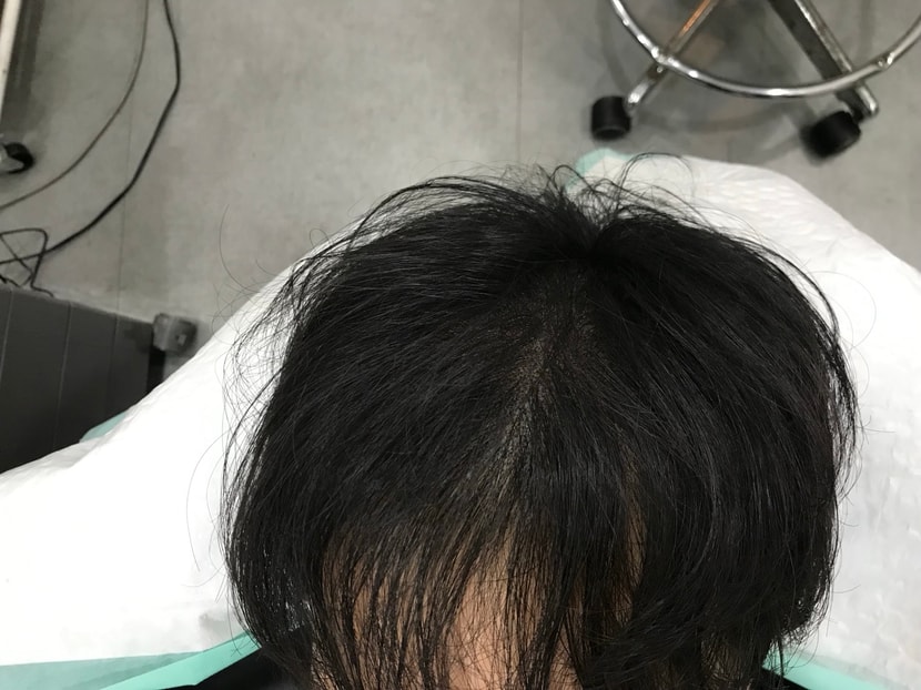 시술후