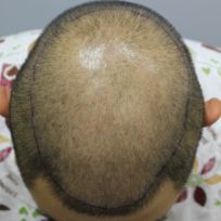 두피문신 무조건 검게 칠한다고 되는게 아니더군요 두피문신 후기(사진)