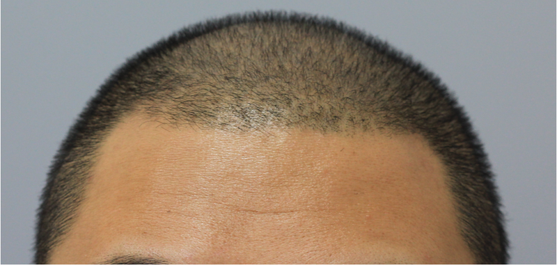 The world looks different with scalp tattoos..Touch 3rd picture added