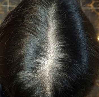 두피문신 받고 삶의 질 수직 상승 (3개월 차)