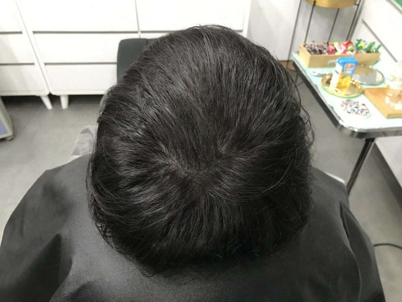 시술후머리감고 말리고