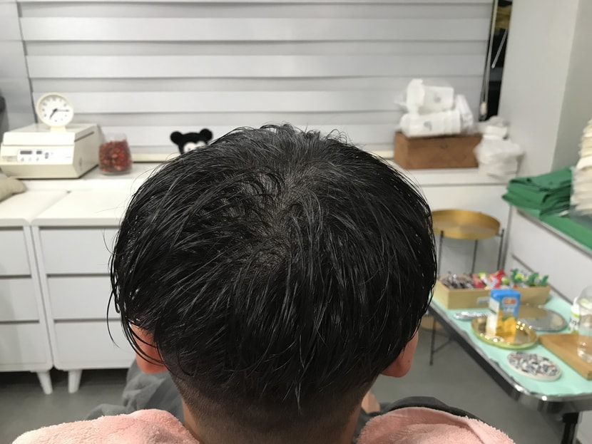 시술후머리감고나서