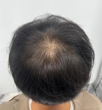시술전