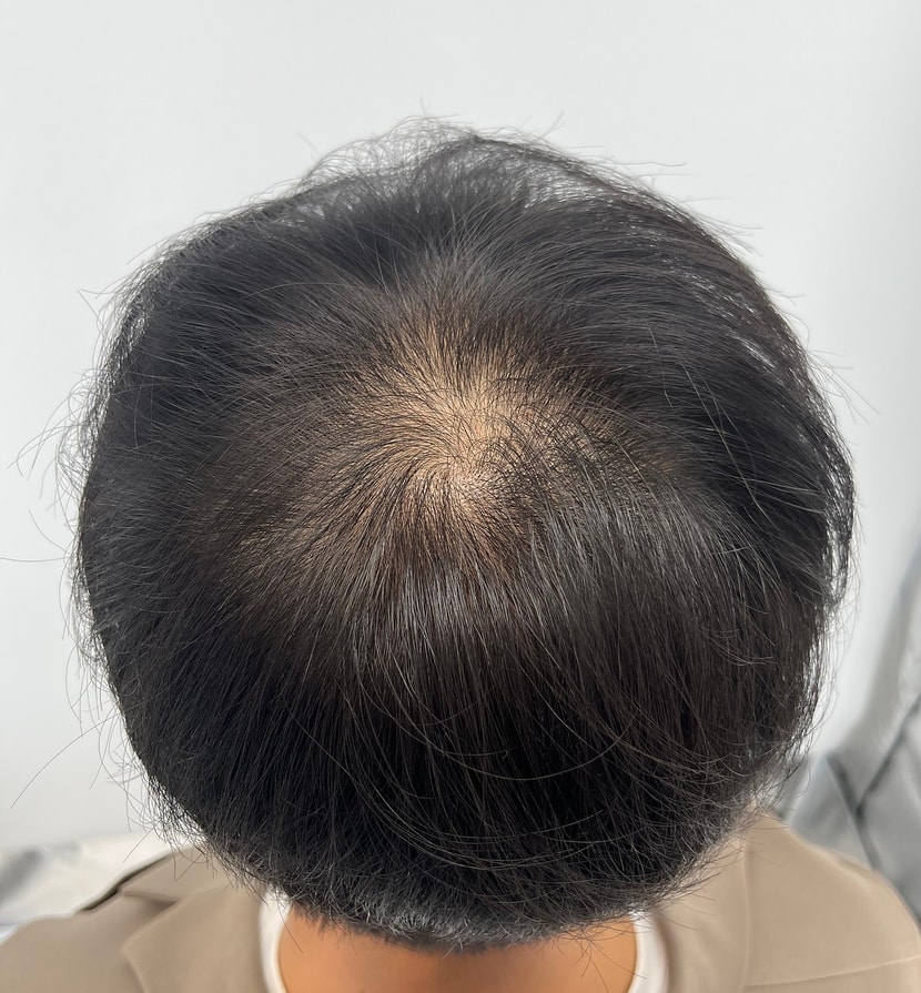 시술전