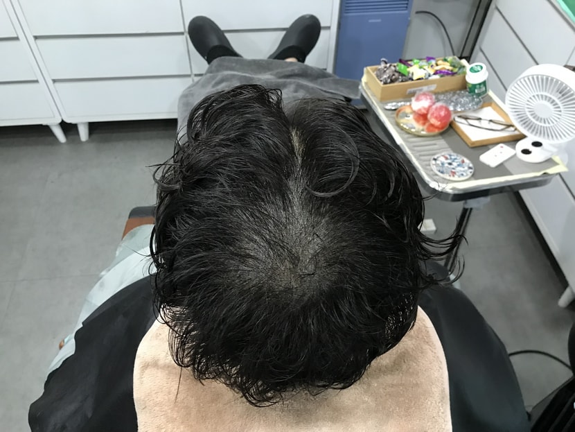 1차 수지침 미세도트 후 