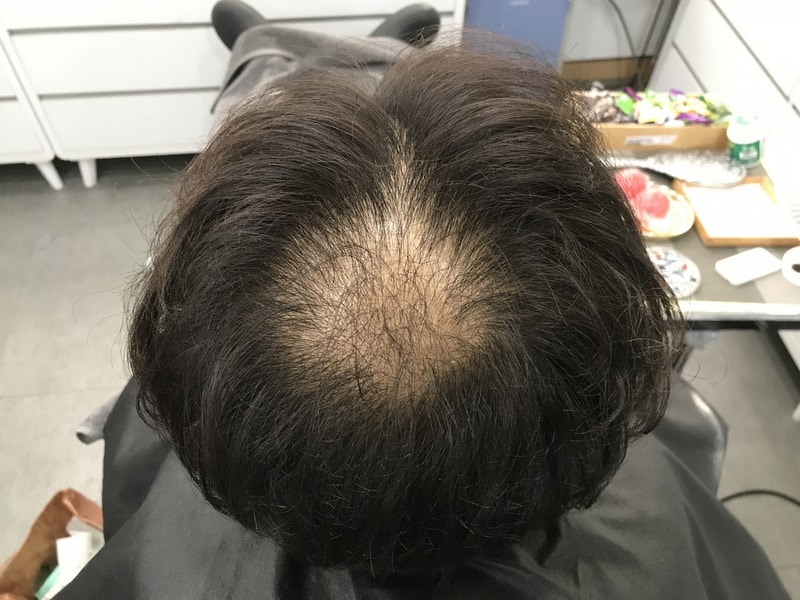 スジチム微細ドット頭頂部頭皮タトゥー体験談です。