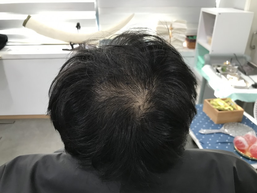 시술전 사진입니다 !