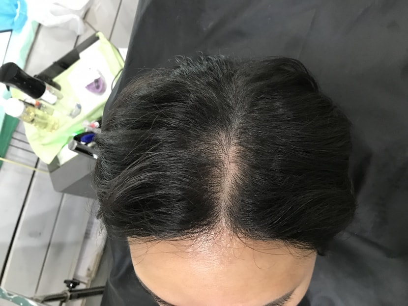 시술전 병원에서 샴푸전