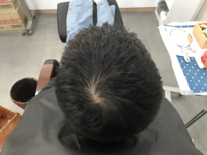시술전