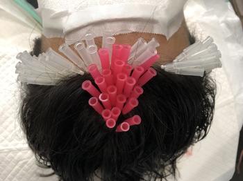 잔머리 재생술 과정 사진