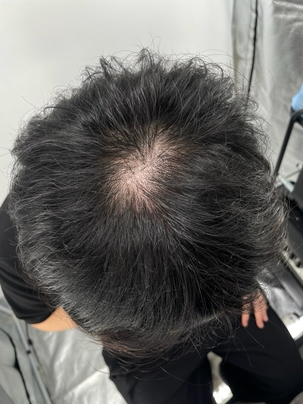 강남뉴헤어 두피문신후기입니다