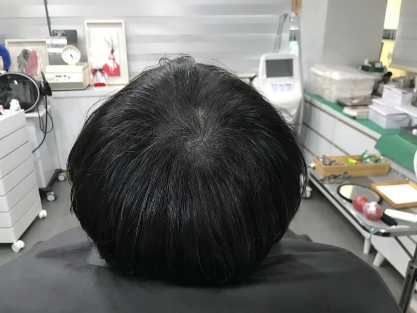 시술후