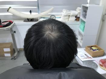 시술전