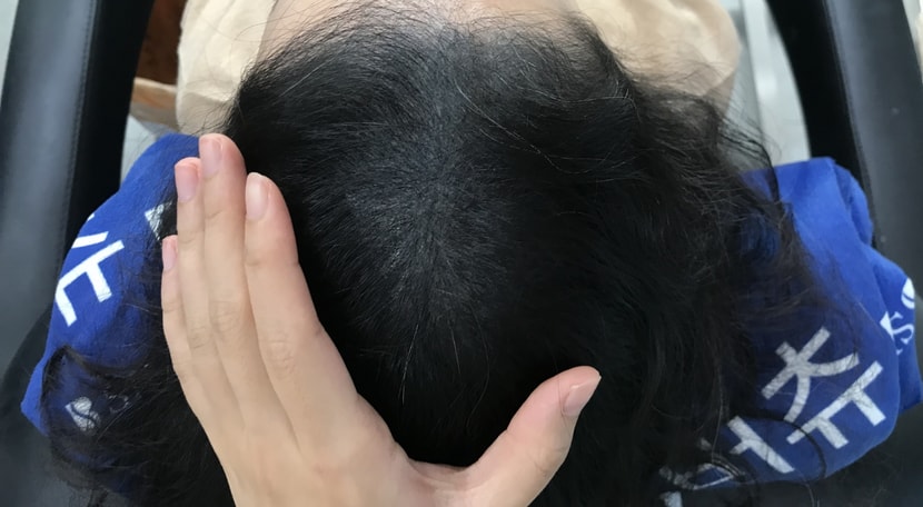 두피문신 3달후