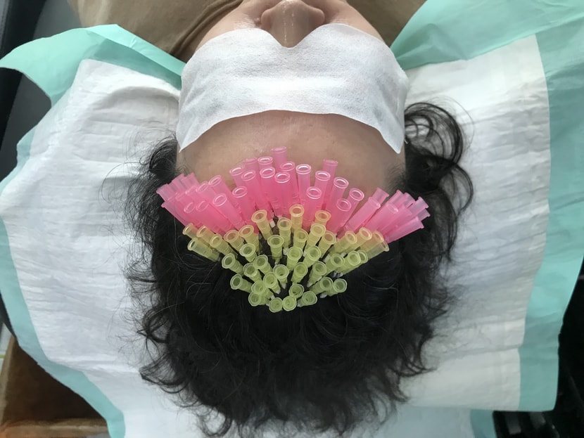 두피에 콜라겐실 시술