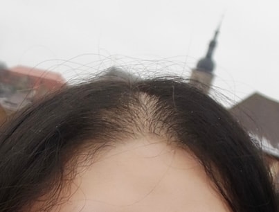 延世ミダイン頭皮タトゥー 約2年経過、リタッチ後の体験談