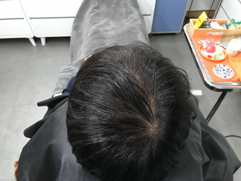 시술 전 말린 머리입니다