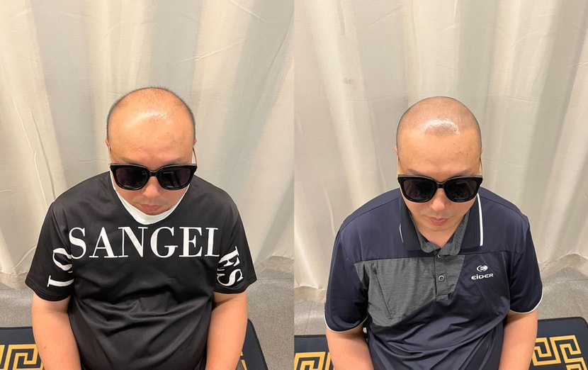 시술전후