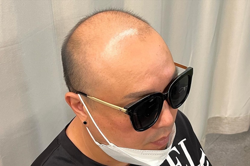 시술전