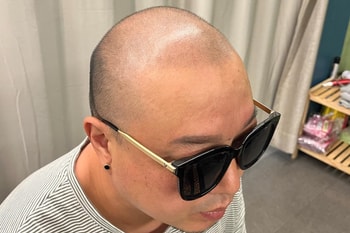 시술후