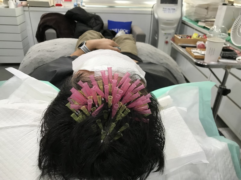 모발 볼륨 리프팅 및 전두부 보강 시술 받았습니다.