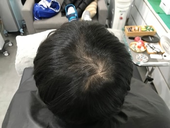 두피문신 전입니다