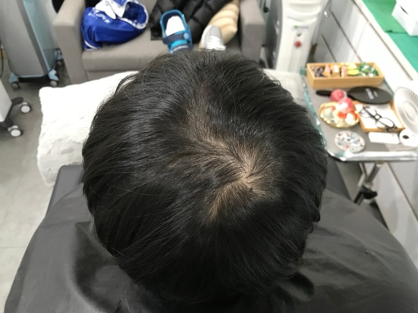 두피문신 전입니다