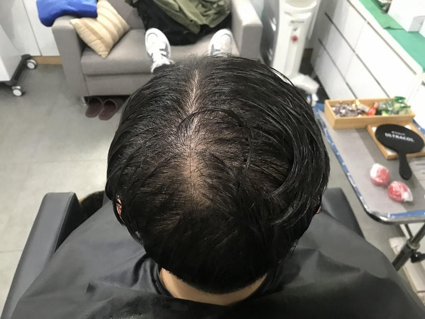시술전 병원에서 샴푸후