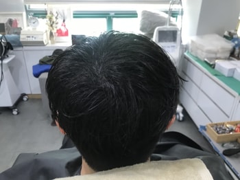 시술후 병원에서 샴푸후