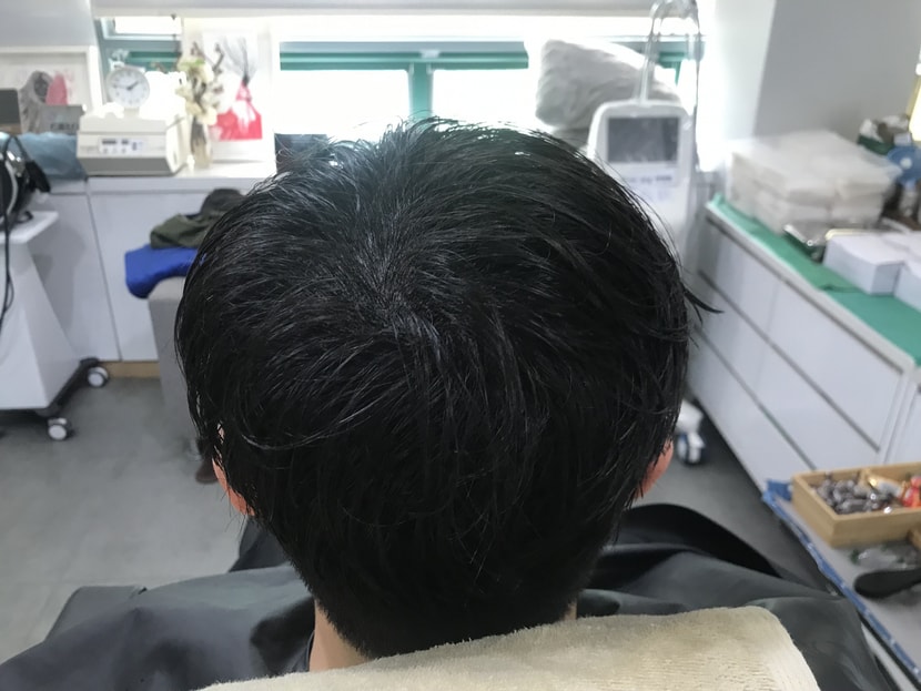 시술후 병원에서 샴푸후