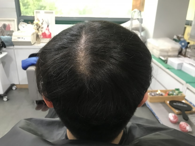 시술전 병원에서 샴푸전