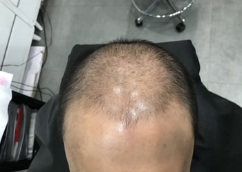 시술 전