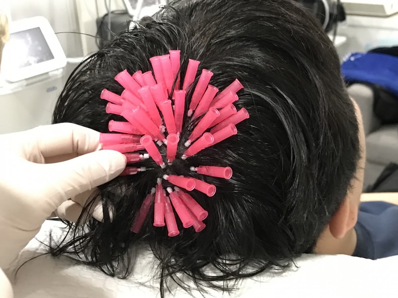 碎发再生术后记。