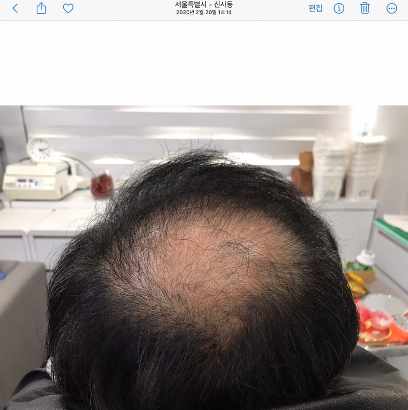 5-year review of scalp tattoo