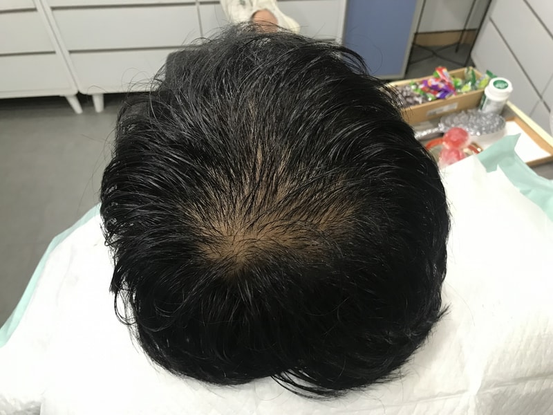 スジチム微細ドットの1次施術をしてきました~